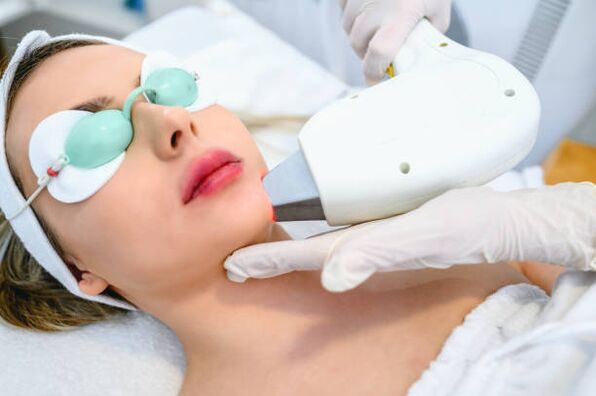 procedura de întinerire a pielii faciale cu laser