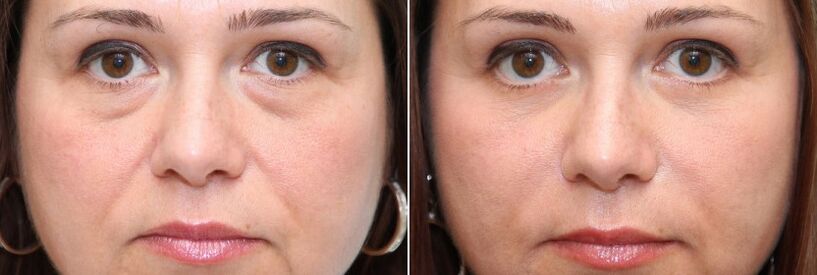 Înainte și după blefaroplastie - îndepărtarea corpului gras de sub ochi și strângerea pielii