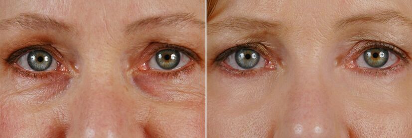 Înainte și după operația cu laser - întinerirea pielii din jurul ochilor