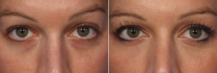 Înainte și după utilizarea materialelor de umplutură injectabile - reducerea cercurilor de sub ochi